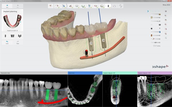 3Shape Implant Studio